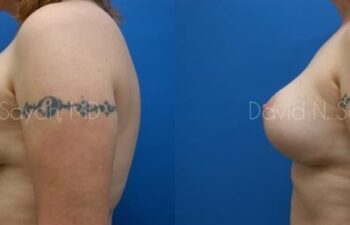 Breast Augmentation And Mastopexy Before and After | Sayah Institute