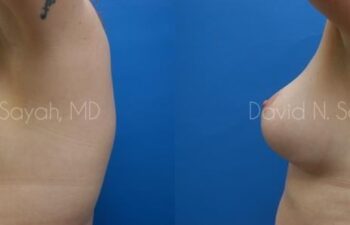 Breast Augmentation And Mastopexy Before and After | Sayah Institute