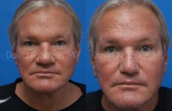 Rhinoplasty Before and After | Sayah Institute
