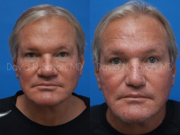 Rhinoplasty Before and After | Sayah Institute