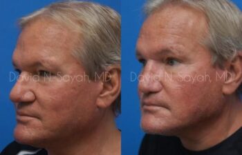 Rhinoplasty Before and After | Sayah Institute