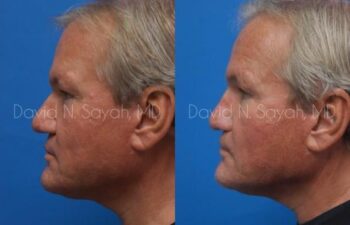 Rhinoplasty Before and After | Sayah Institute