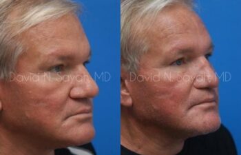Rhinoplasty Before and After | Sayah Institute