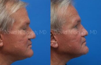 Rhinoplasty Before and After | Sayah Institute