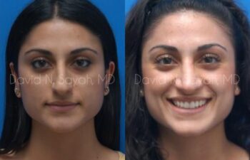 Rhinoplasty Before and After | Sayah Institute