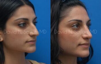 Rhinoplasty Before and After | Sayah Institute
