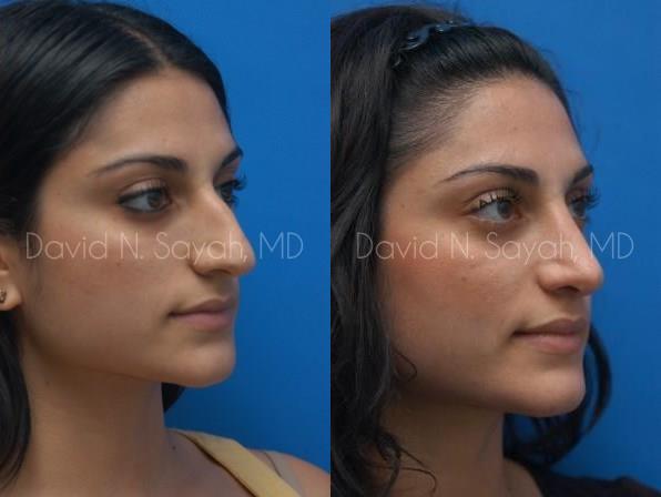Rhinoplasty Before and After | Sayah Institute