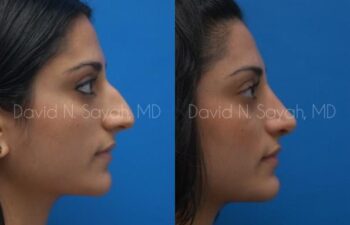 Rhinoplasty Before and After | Sayah Institute