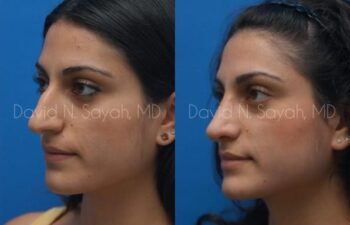 Rhinoplasty Before and After | Sayah Institute