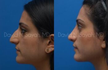 Rhinoplasty Before and After | Sayah Institute