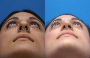Rhinoplasty Before and After | Sayah Institute