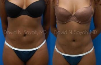 Liposuction Before and After | Sayah Institute