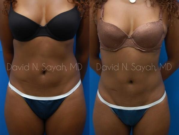 Liposuction Before and After | Sayah Institute