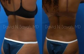 Liposuction Before and After | Sayah Institute