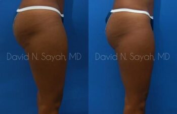 Liposuction Before and After | Sayah Institute