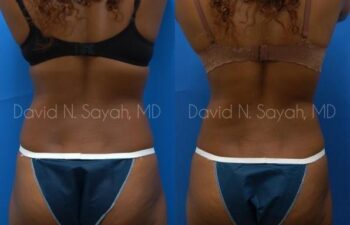 Liposuction Before and After | Sayah Institute