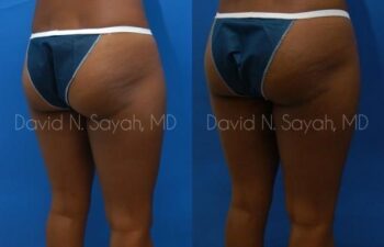 Liposuction Before and After | Sayah Institute