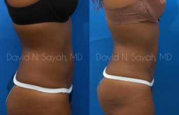 Liposuction Before and After | Sayah Institute