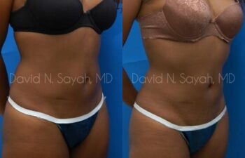 Liposuction Before and After | Sayah Institute