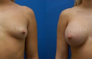 Breast Augmentation Before and After | Sayah Institute