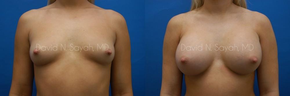 Breast Augmentation Before and After | Sayah Institute