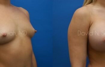 Breast Augmentation Before and After | Sayah Institute