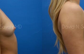 Breast Augmentation Before and After | Sayah Institute