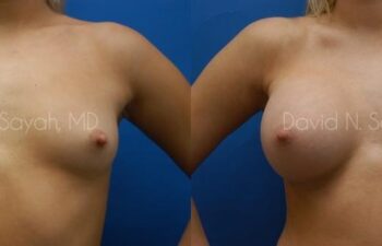 Breast Augmentation Before and After | Sayah Institute
