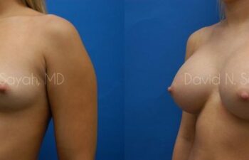 Breast Augmentation Before and After | Sayah Institute
