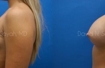 Breast Augmentation Before and After | Sayah Institute