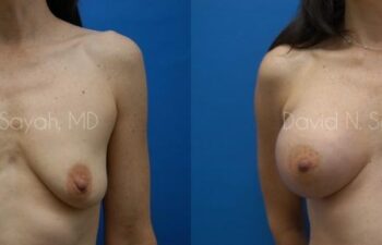 Breast Augmentation And Mastopexy Before and After | Sayah Institute