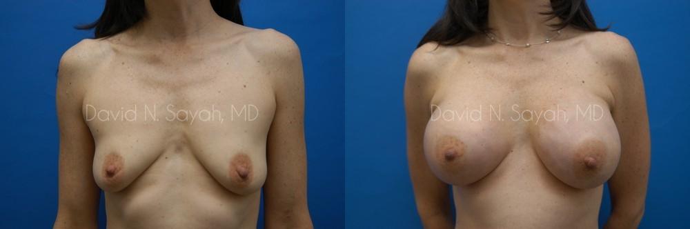 Breast Augmentation And Mastopexy Before and After | Sayah Institute