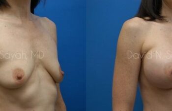 Breast Augmentation And Mastopexy Before and After | Sayah Institute