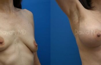 Breast Augmentation And Mastopexy Before and After | Sayah Institute