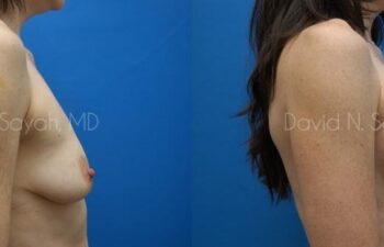Breast Augmentation And Mastopexy Before and After | Sayah Institute