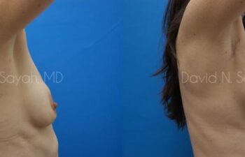 Breast Augmentation And Mastopexy Before and After | Sayah Institute
