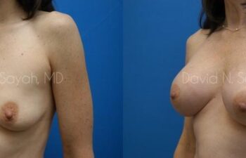 Breast Augmentation And Mastopexy Before and After | Sayah Institute