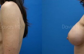 Breast Augmentation And Mastopexy Before and After | Sayah Institute