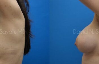 Breast Augmentation And Mastopexy Before and After | Sayah Institute