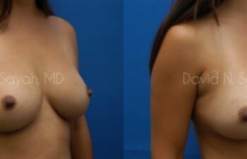 Breast Implant Exchange Before and After | Sayah Institute