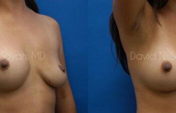 Breast Implant Exchange Before and After | Sayah Institute