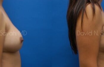 Breast Implant Exchange Before and After | Sayah Institute