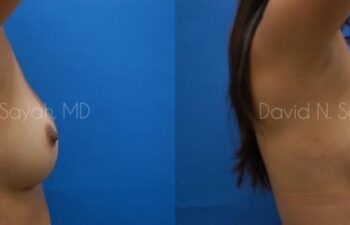 Breast Implant Exchange Before and After | Sayah Institute