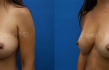 Breast Implant Exchange Before and After | Sayah Institute