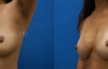 Breast Implant Exchange Before and After | Sayah Institute