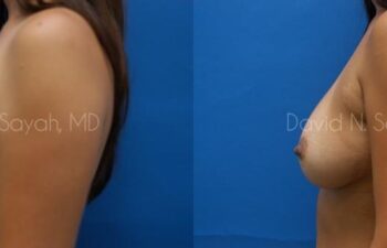 Breast Implant Exchange Before and After | Sayah Institute