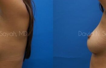 Breast Implant Exchange Before and After | Sayah Institute