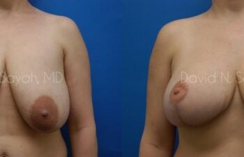Breast Reduction Before and After | Sayah Institute