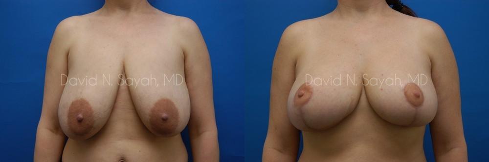 Breast Reduction Before and After | Sayah Institute
