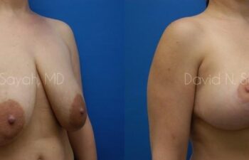 Breast Reduction Before and After | Sayah Institute